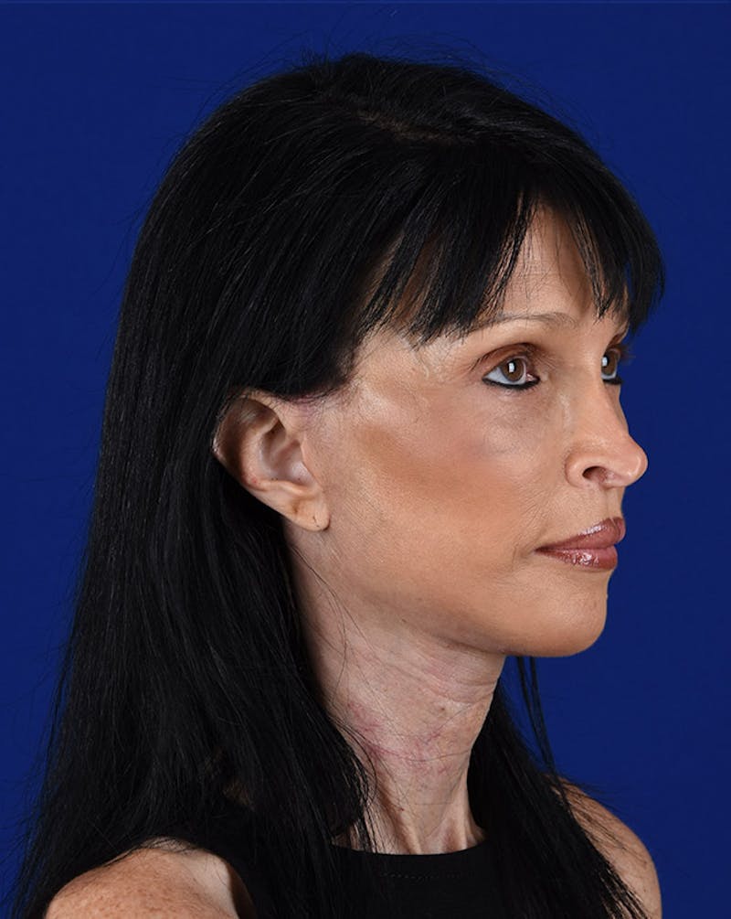 Facelift Before & After Gallery - Patient 10669928 - Image 4
