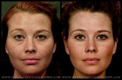 Sculptra before and after results 