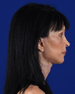 Facelift Before & After Gallery - Patient 10669928 - Image 6