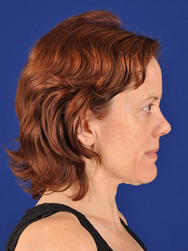 Facelift Before & After Gallery - Patient 10669934 - Image 5