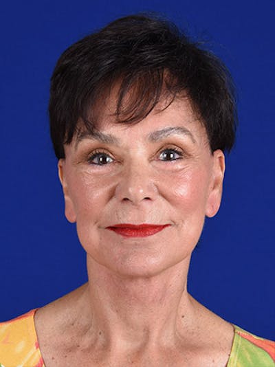 Facelift Before & After Gallery - Patient 10669940 - Image 2