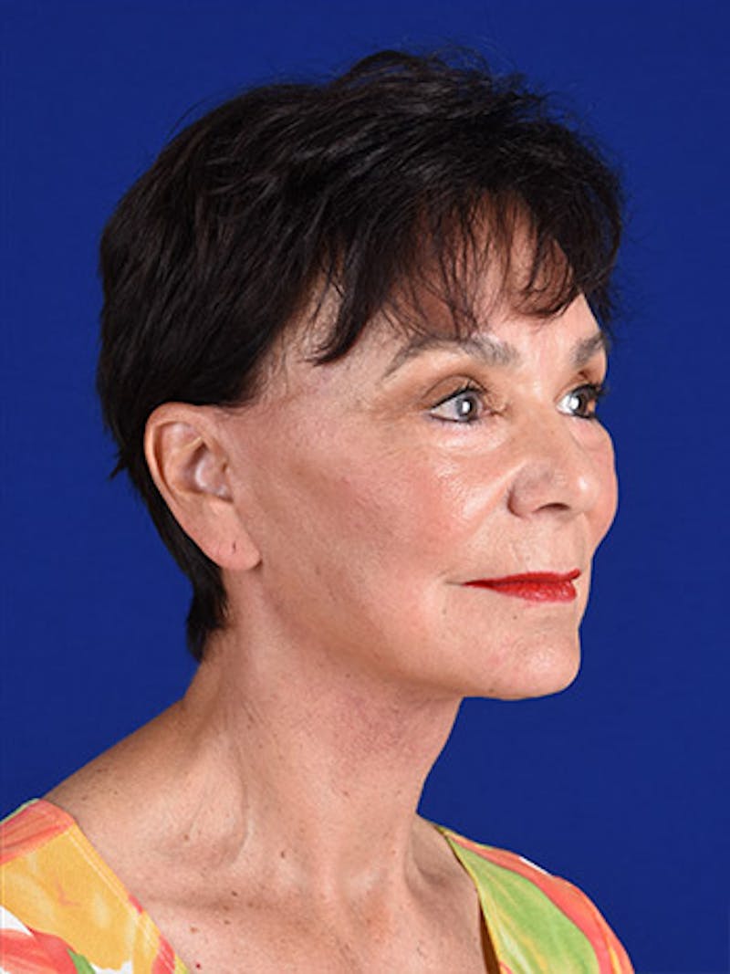 Facelift Before & After Gallery - Patient 10669940 - Image 4