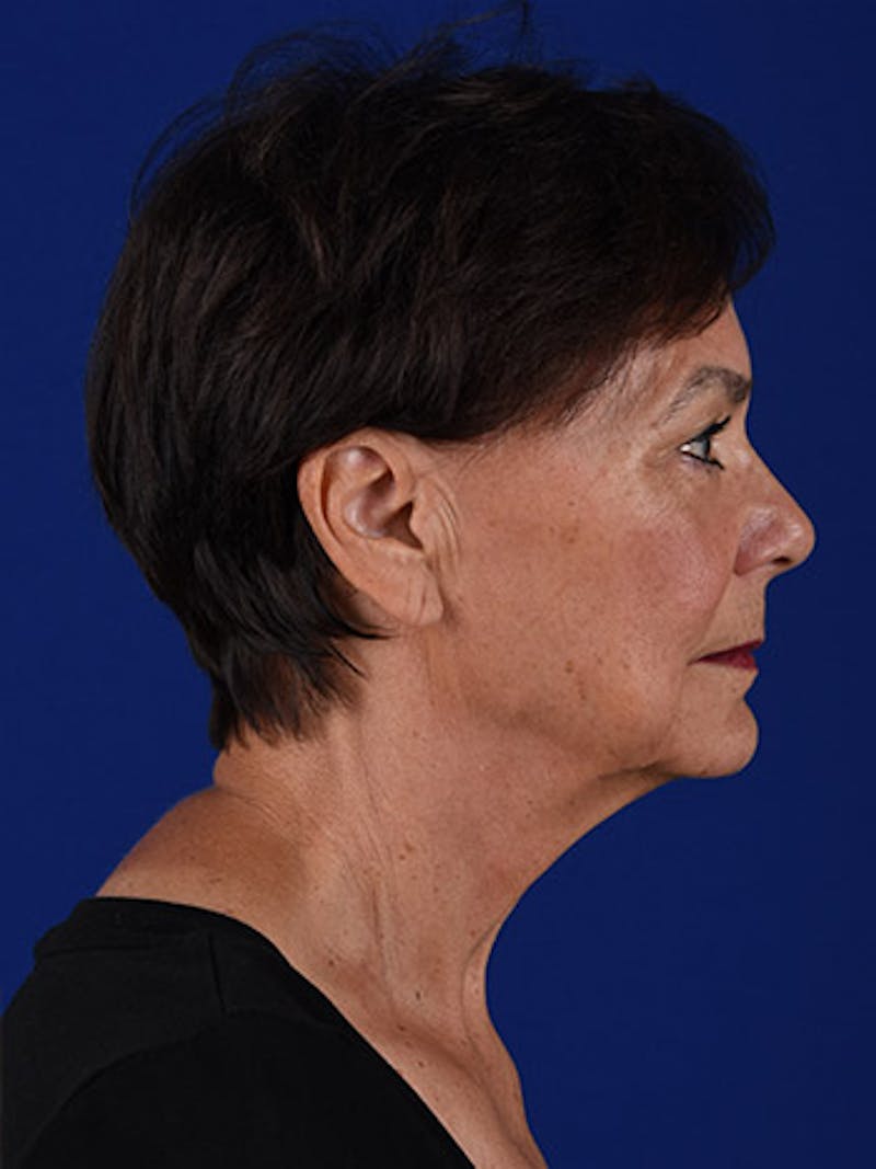 Facelift Before & After Gallery - Patient 10669940 - Image 5