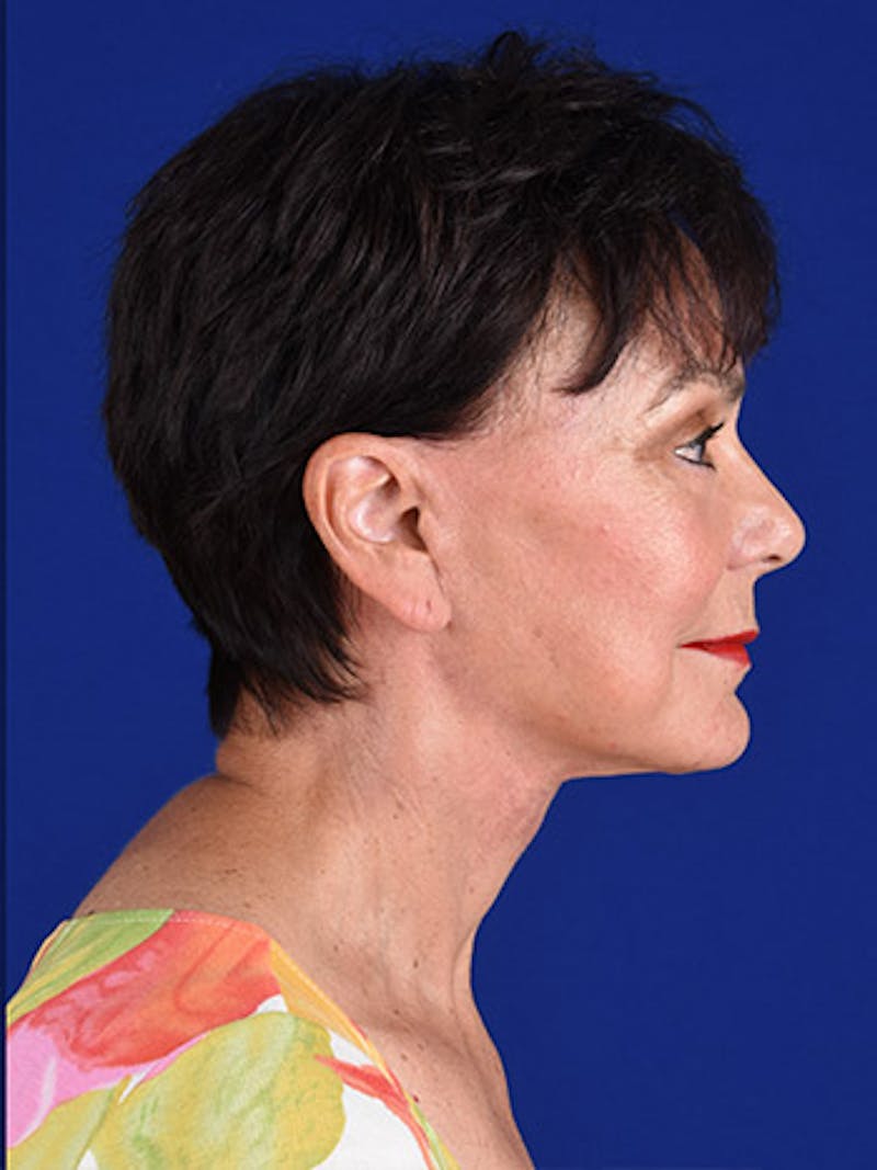 Facelift Before & After Gallery - Patient 10669940 - Image 6