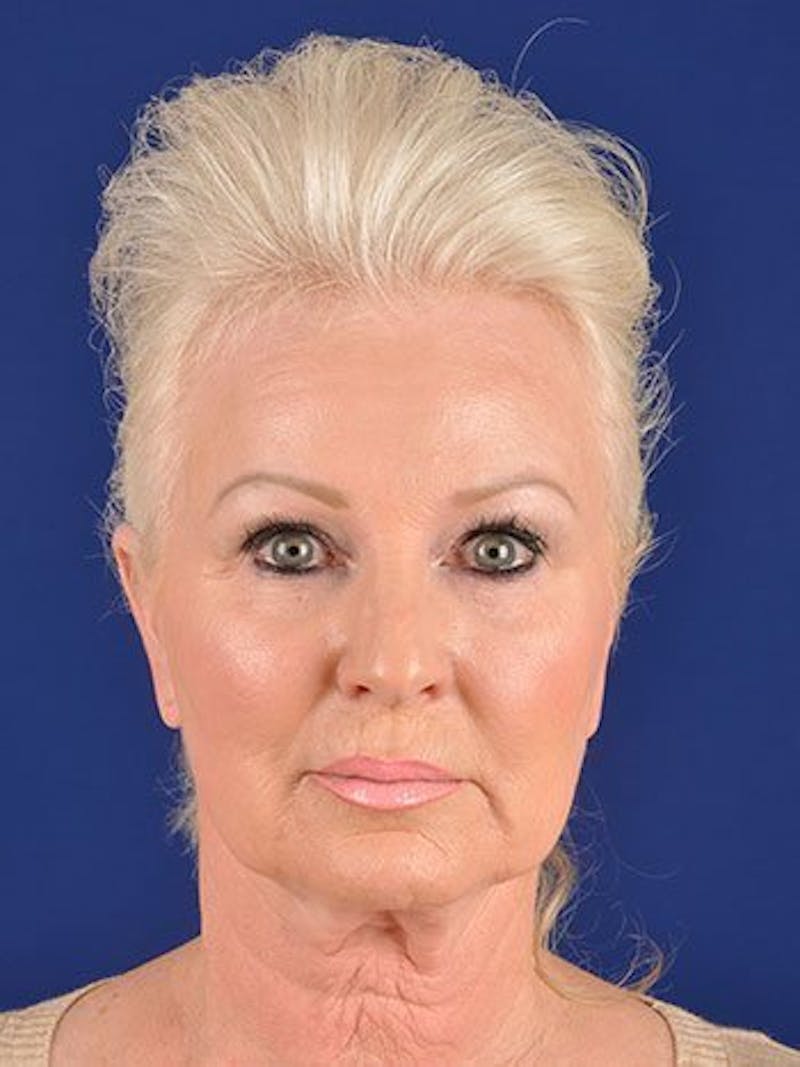 Facelift Before & After Gallery - Patient 10669941 - Image 1