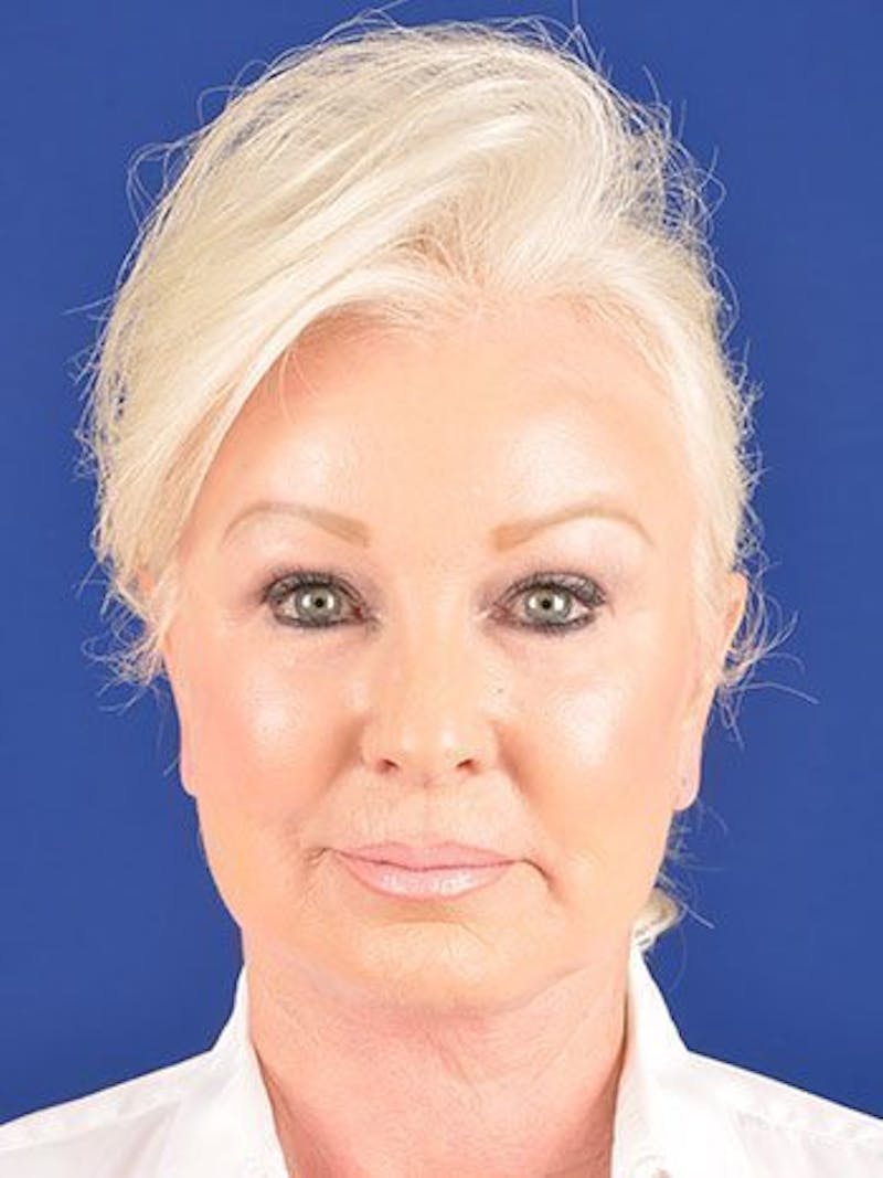 Facelift Before & After Gallery - Patient 10669941 - Image 2