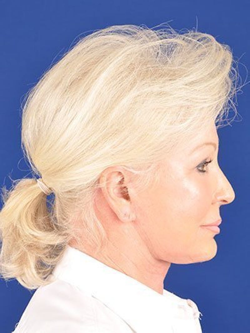 Facelift Before & After Gallery - Patient 10669941 - Image 6