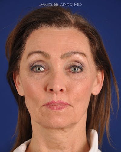 Facelift Before & After Gallery - Patient 10669943 - Image 1