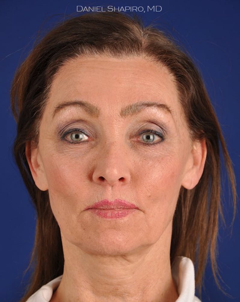 Facelift Before & After Gallery - Patient 10669943 - Image 1