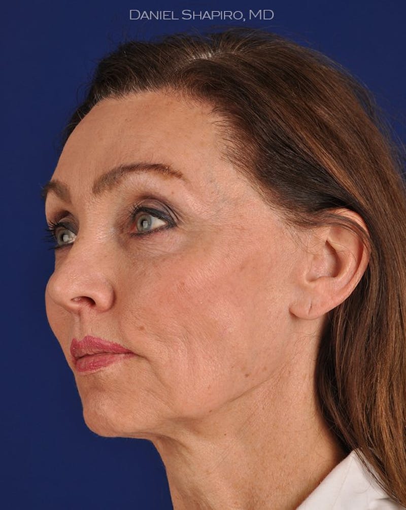 Facelift Before & After Gallery - Patient 10669943 - Image 3
