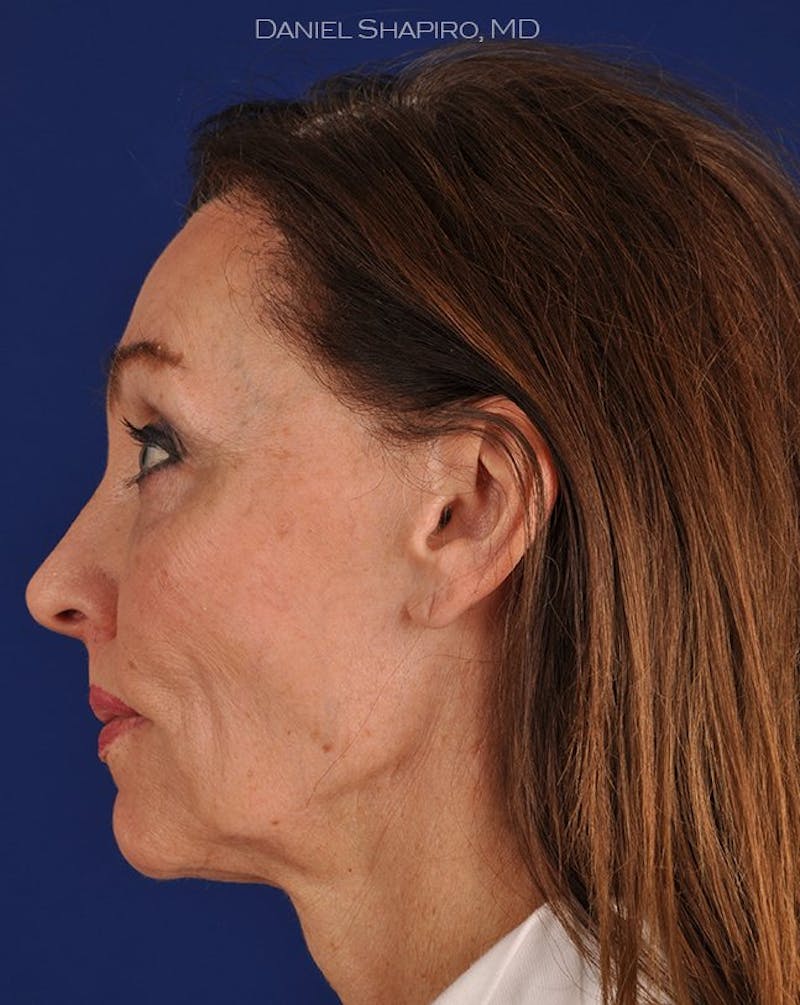 Facelift Before & After Gallery - Patient 10669943 - Image 5