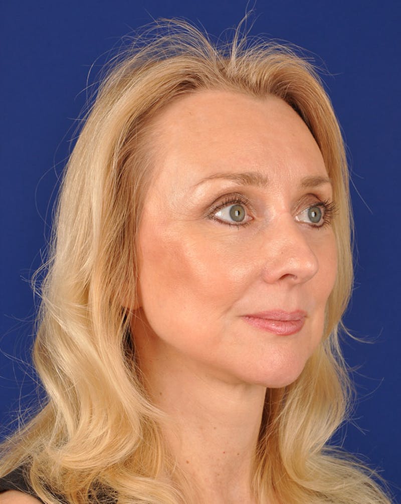 Facelift Before & After Gallery - Patient 10669946 - Image 4