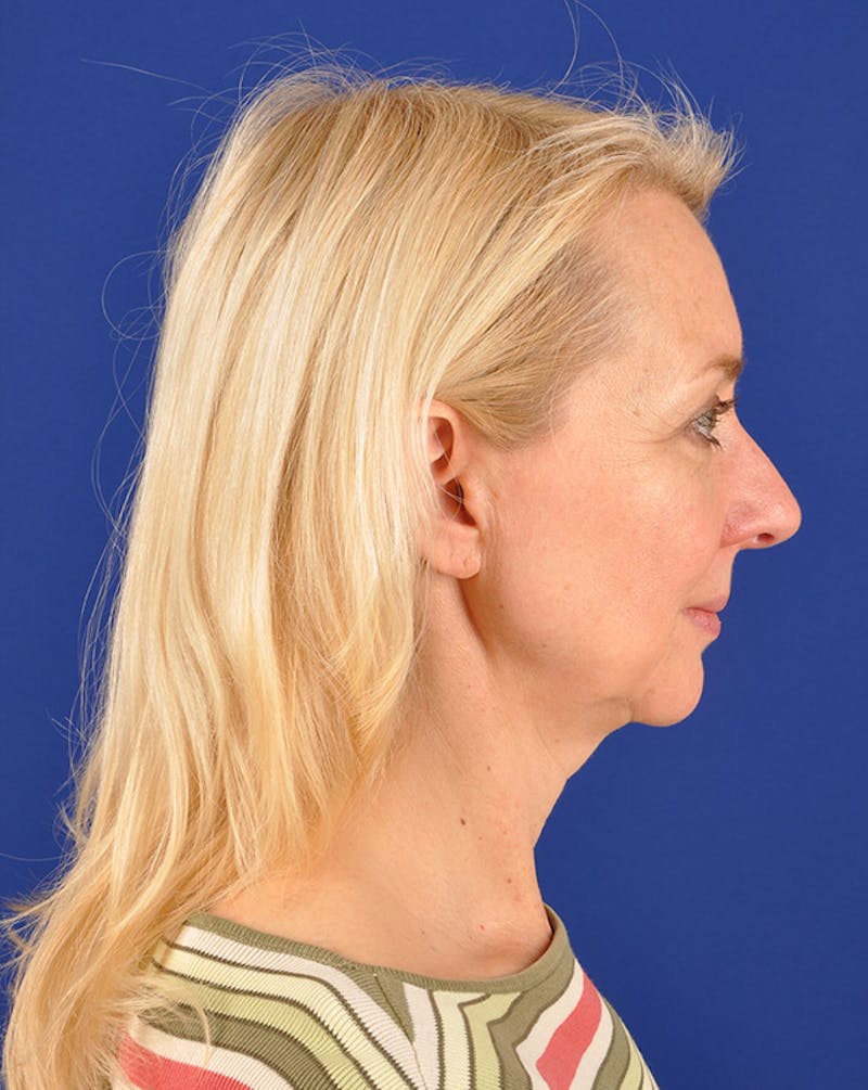 Facelift Before & After Gallery - Patient 10669946 - Image 5