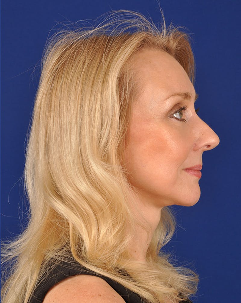 Facelift Before & After Gallery - Patient 10669946 - Image 6