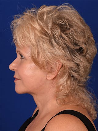 Facelift Before & After Gallery - Patient 10669947 - Image 6