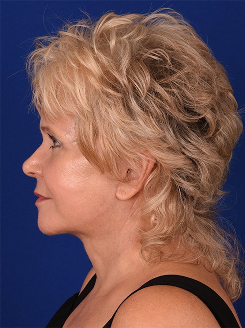 Facelift Before & After Gallery - Patient 10669947 - Image 6