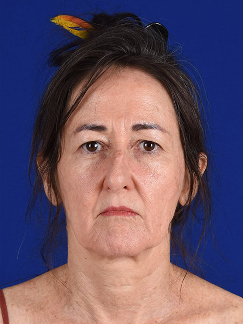 Facelift Before & After Gallery - Patient 10669948 - Image 1
