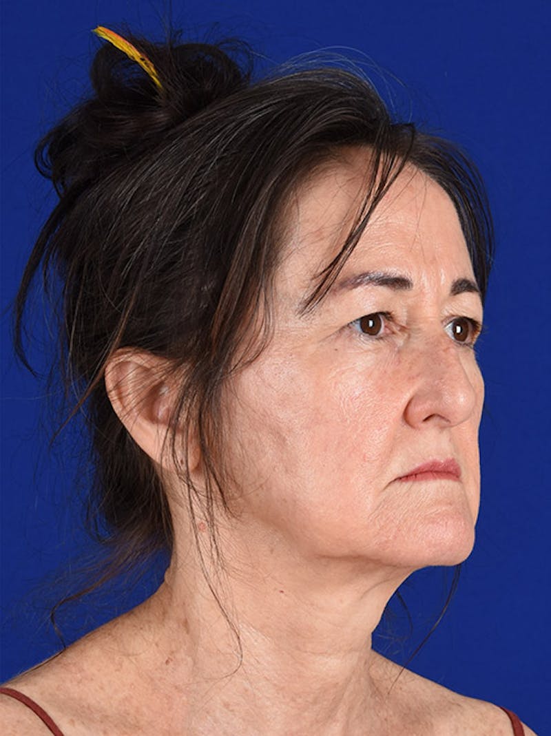 Facelift Before & After Gallery - Patient 10669948 - Image 3