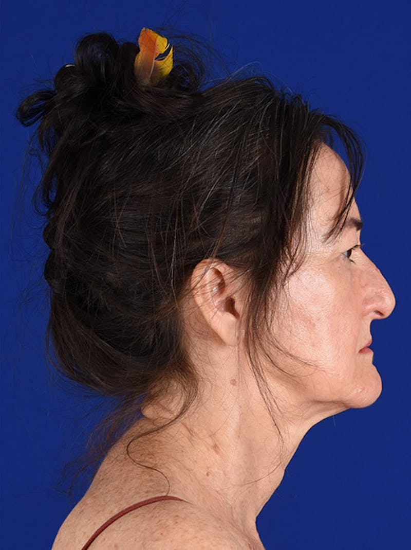 Facelift Before & After Gallery - Patient 10669948 - Image 5