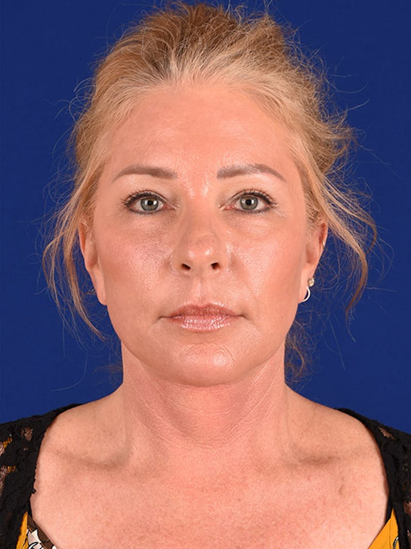 Facelift Before & After Gallery - Patient 10669951 - Image 2