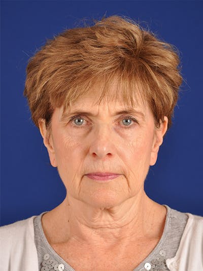 Facelift Before & After Gallery - Patient 10669952 - Image 1