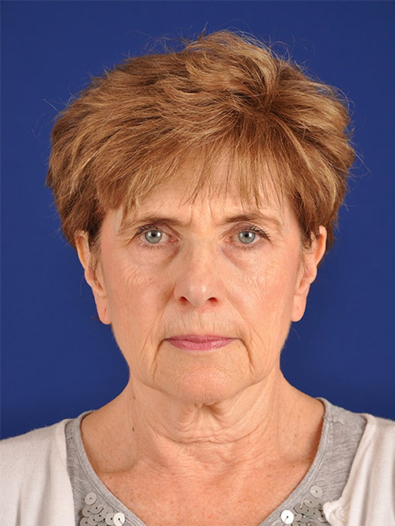 Facelift Before & After Gallery - Patient 10669952 - Image 1