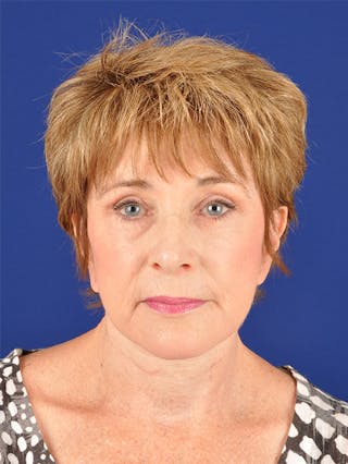 Facelift Before & After Gallery - Patient 10669952 - Image 2