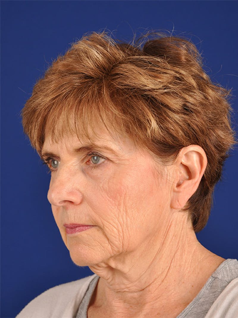 Facelift Before & After Gallery - Patient 10669952 - Image 3