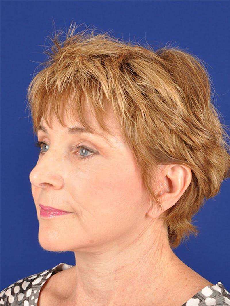 Facelift Before & After Gallery - Patient 10669952 - Image 4