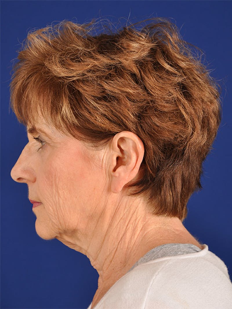 Facelift Before & After Gallery - Patient 10669952 - Image 5