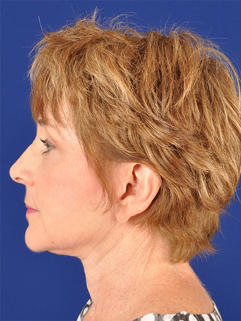 Facelift Before & After Gallery - Patient 10669952 - Image 6