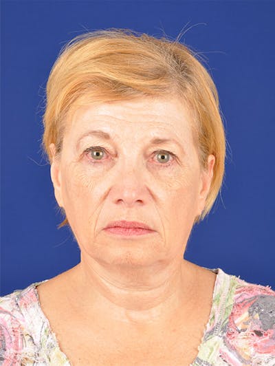 Facelift Before & After Gallery - Patient 10669953 - Image 1
