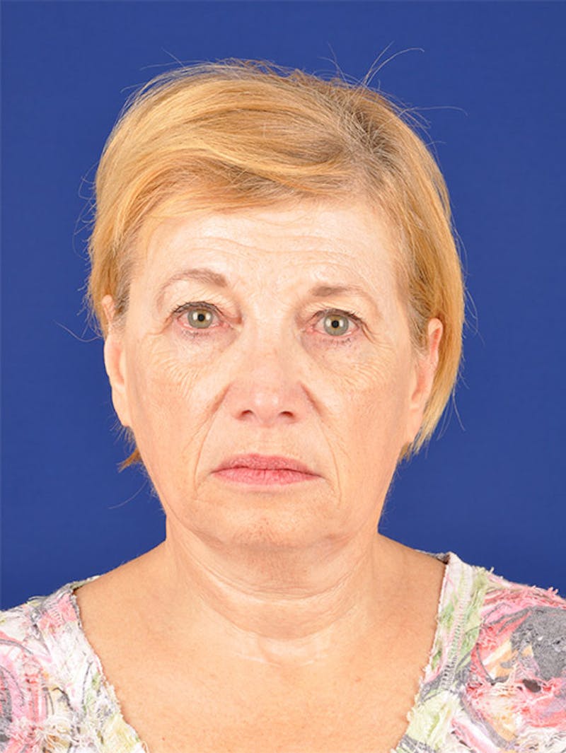 Facelift Before & After Gallery - Patient 10669953 - Image 1