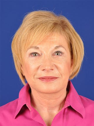 Facelift Before & After Gallery - Patient 10669953 - Image 2