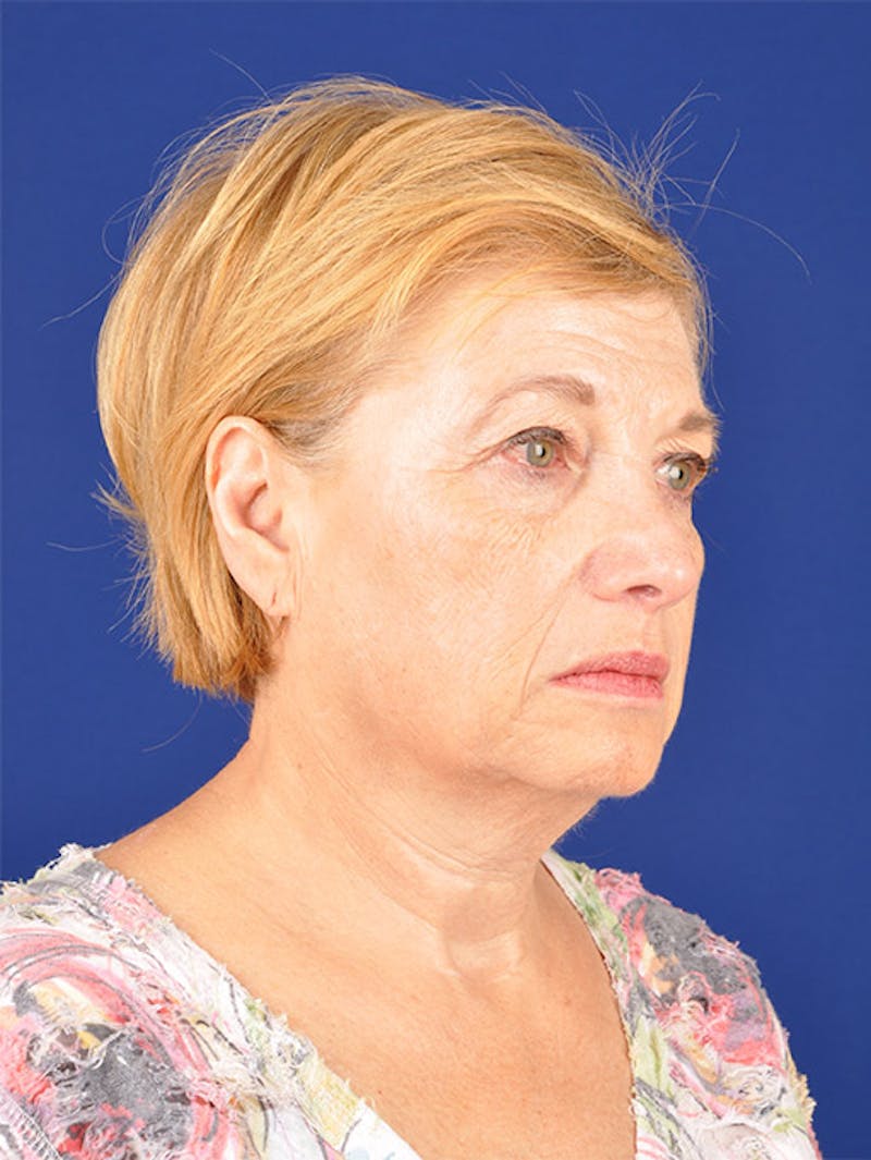 Facelift Before & After Gallery - Patient 10669953 - Image 3