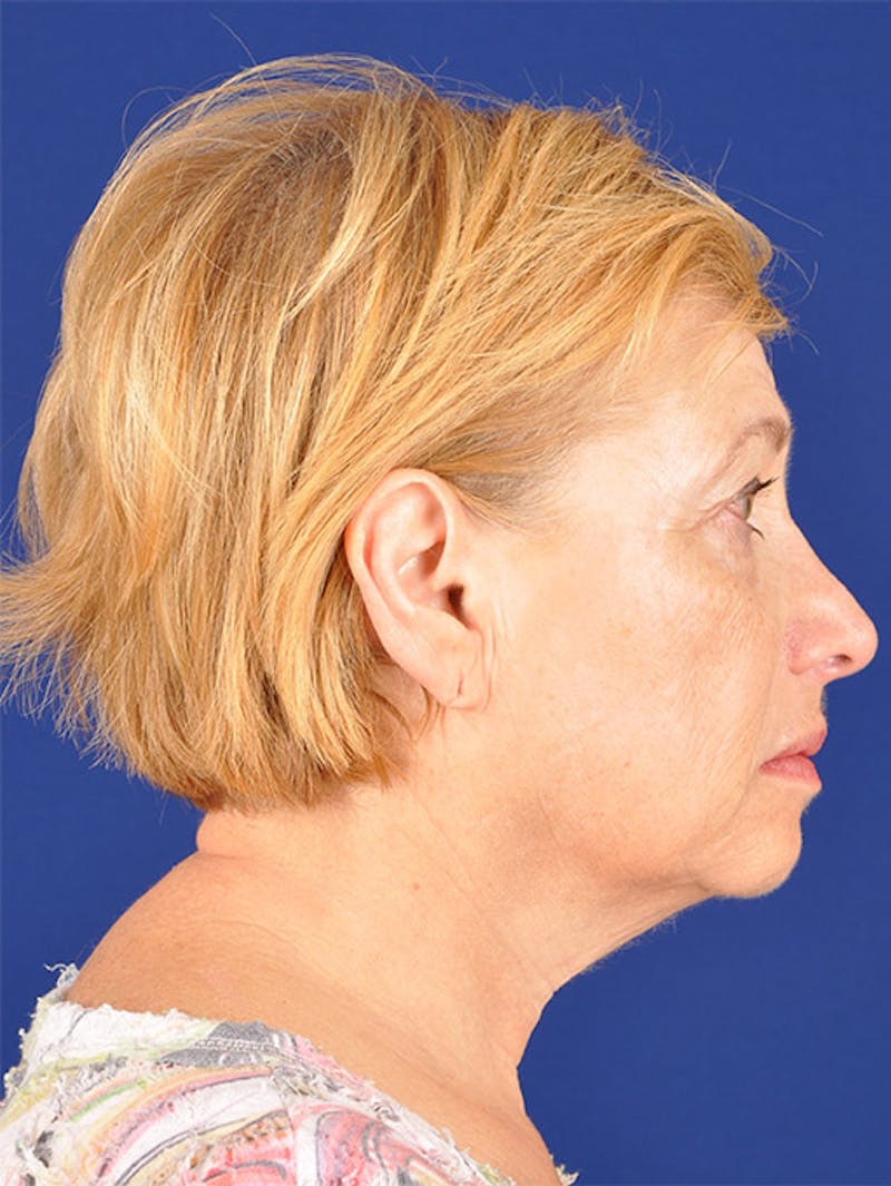 Facelift Before & After Gallery - Patient 10669953 - Image 5