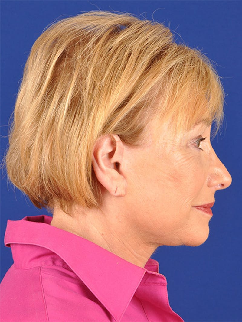 Facelift Before & After Gallery - Patient 10669953 - Image 6
