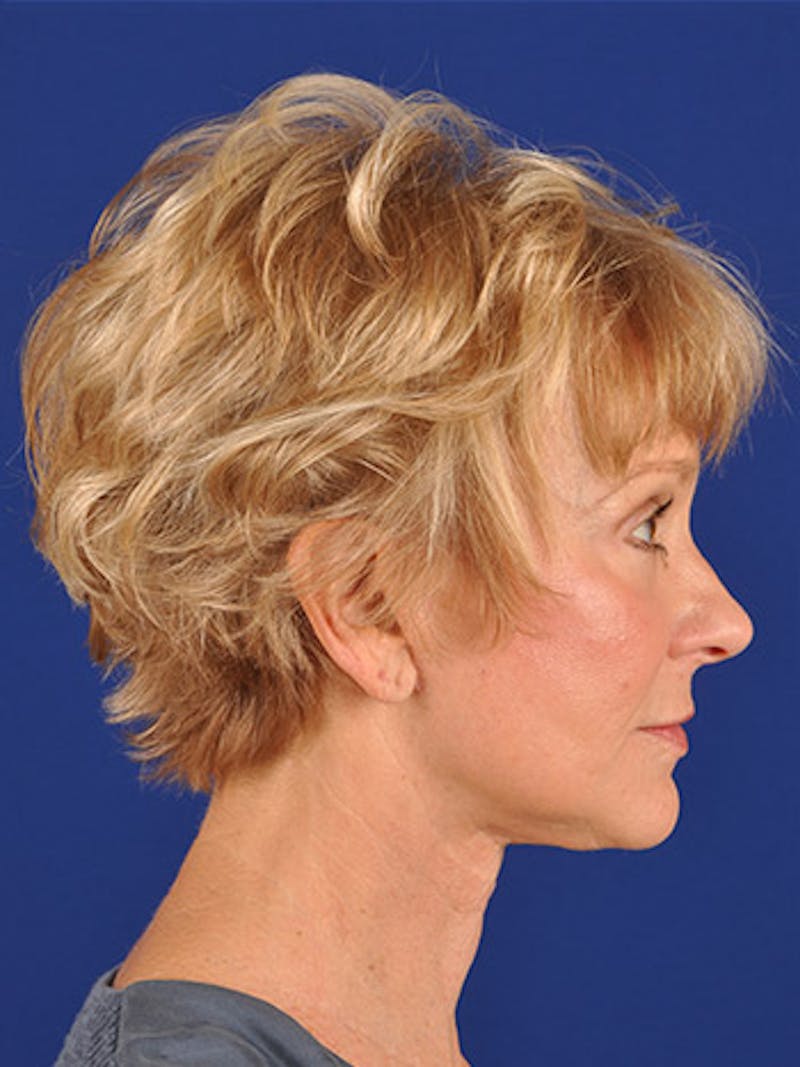 Facelift Before & After Gallery - Patient 10669954 - Image 6