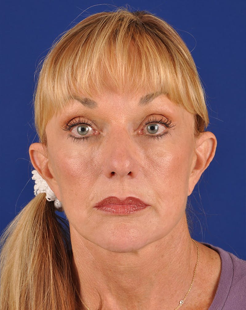 Facelift Before & After Gallery - Patient 10669955 - Image 2