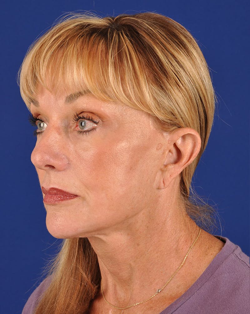 Facelift Before & After Gallery - Patient 10669955 - Image 4