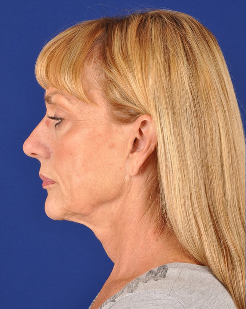 Facelift Before & After Gallery - Patient 10669955 - Image 5
