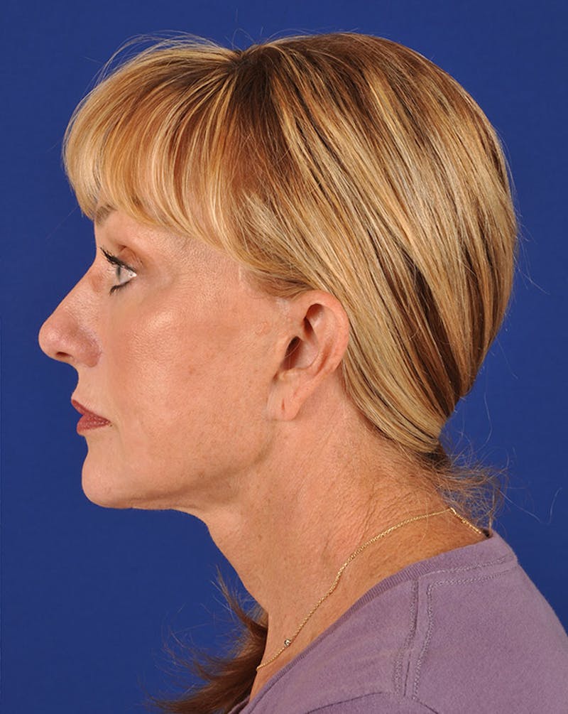 Facelift Before & After Gallery - Patient 10669955 - Image 6