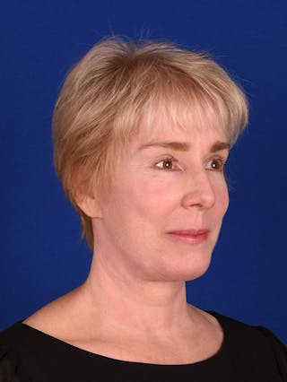 Facelift Before & After Gallery - Patient 10669956 - Image 4