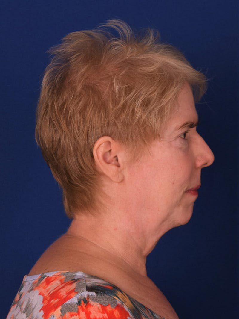 Facelift Before & After Gallery - Patient 10669956 - Image 5