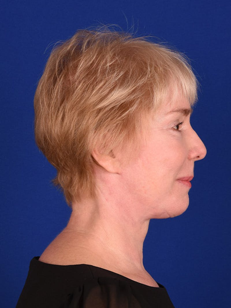 Facelift Before & After Gallery - Patient 10669956 - Image 6