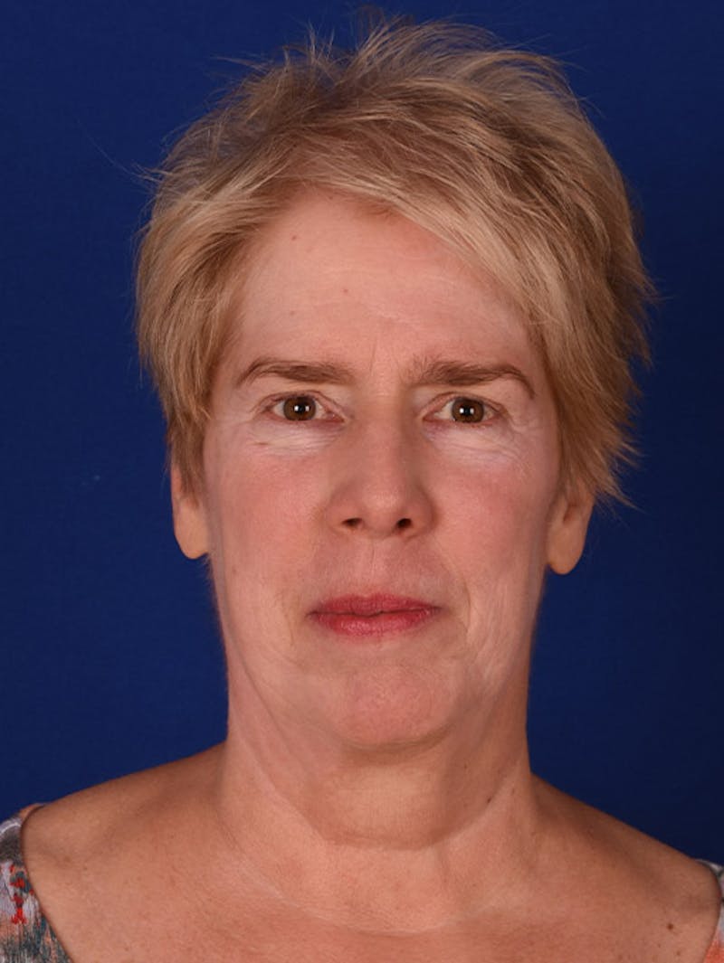 Facelift Before & After Gallery - Patient 10669956 - Image 7