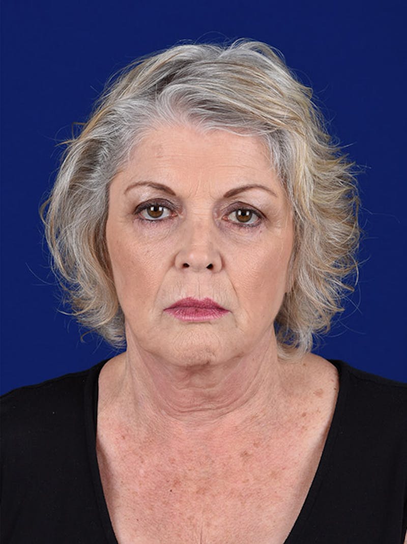 Facelift Before & After Gallery - Patient 10669957 - Image 1