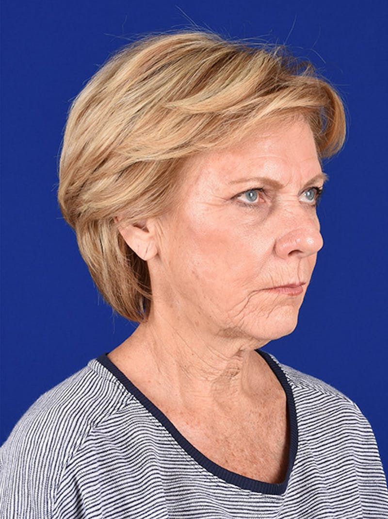 Facelift Before & After Gallery - Patient 10669958 - Image 3
