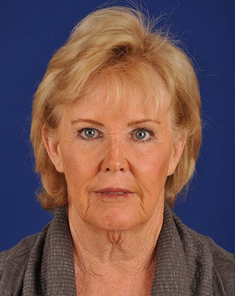 Facelift Before & After Gallery - Patient 10669959 - Image 1