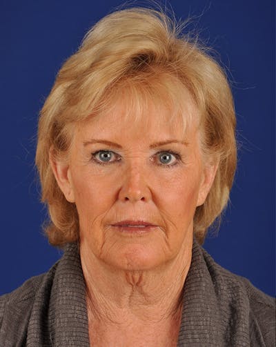 Facelift Before & After Gallery - Patient 10669959 - Image 1